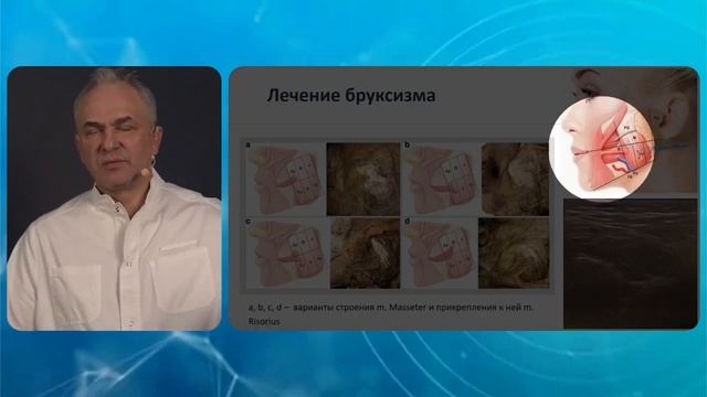 Ботулинотерапия при лицевых болях. Мастер-класс. NeuroRussia 2025