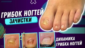 Лечение_грибка_ногтей_⁄_как_вылечить_грибок_ногтей_⁄грибок_ногтей