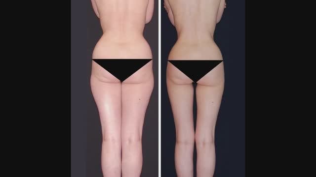 РУЧНАЯ ПЛАСТИКА ТЕЛА И ЛИЦА NEWBODYKA – КОРРЕКЦИЯ ФИГУРЫ. КАЛИНИН АЛЕКСЕЙ. МОСКВА.