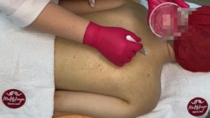 Ультразвуковая чистка спины + пилинг с пробиотиком INIT PROF