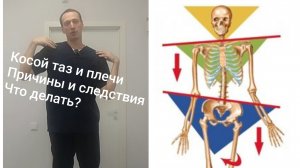 Косой таз и плечи. Причины и следствия. Что делать?