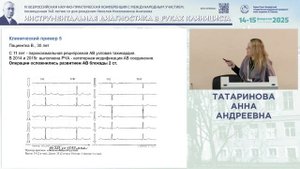 Ценность ЭКГ-нагрузочных проб при нарушениях сердечной проводимости