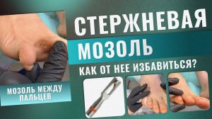 Стержневая мозоль. Как от нее избавиться?