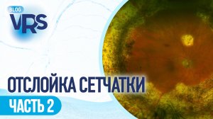 Отслойка сетчатки / часть 2