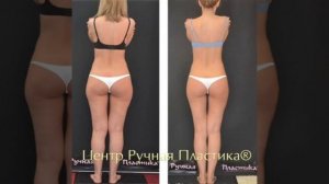 Ручная липосакция. Массаж . Центр Ручная Пластика® Волынкина Ю.А .ruchnaya-plastika.ru