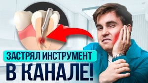 В зубе сломался инструмент 😱 Что делать — удалять или можно спасти?