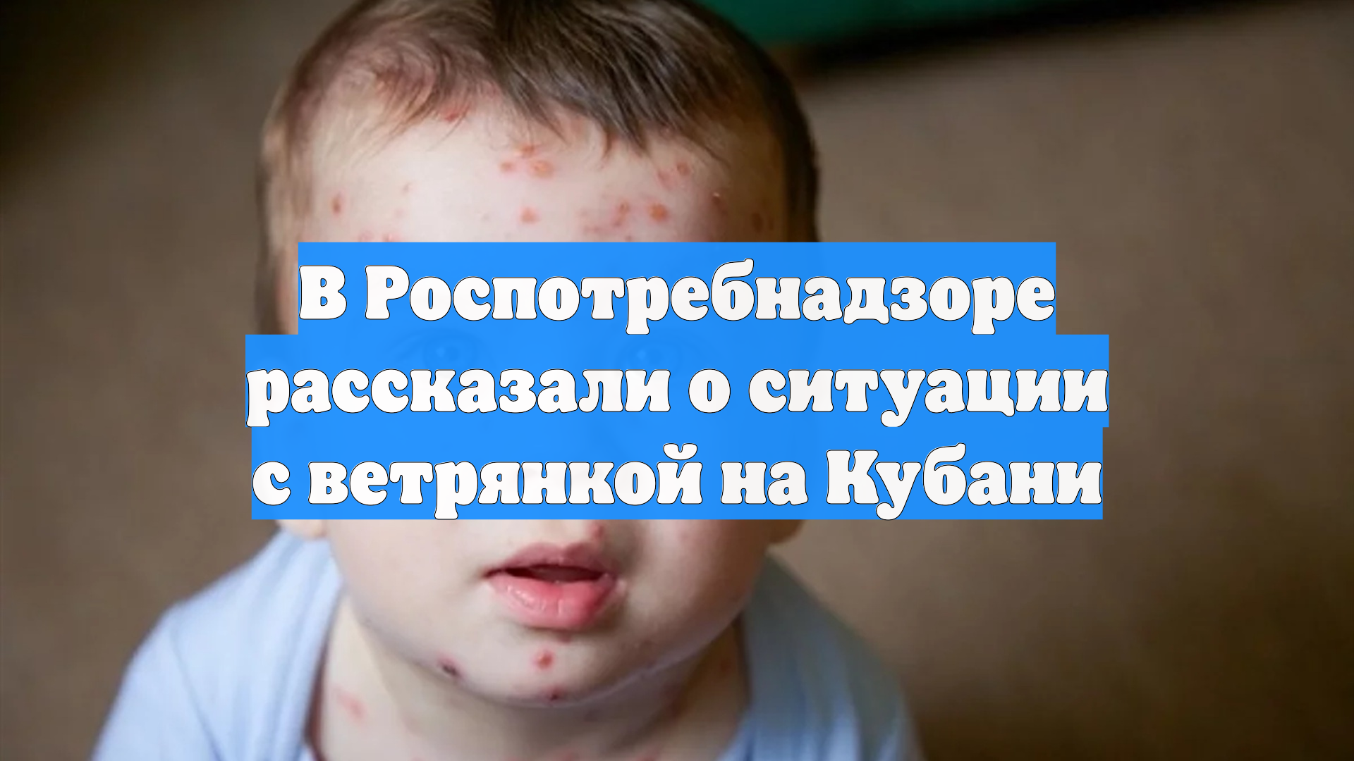 В Роспотребнадзоре рассказали о ситуации с ветрянкой на Кубани