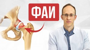 Боль в тазобедренном суставе из-за фемороацетабулярного импинджмента. Что это? Как лечить?