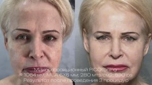 Процедуры на Vydence До и После в России 2025  (Виденс До и После в России 2025): Примеры работы.