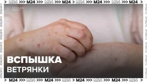 Новые случаи заболевания ветрянкой зафиксированы по всей России - Москва 24
