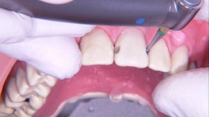 Реставрация передних зубов (2 часть, удаление кариеса)