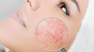 Куперозная кожа