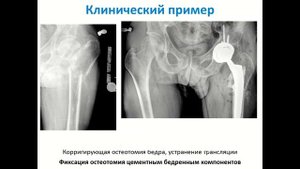 Эндопротезирование при последствиях переломов проксимального отдела бедра.