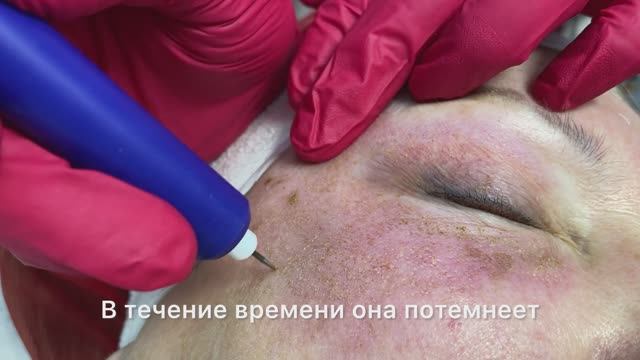 Холодная, абляционная плазма и коллагеновая пластина INN 3D Matrix бренда «MALITSKAYA»