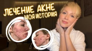 МОЯ ИСТОРИЯ АКНЕ | Как я СПАСЛА СВОЮ КОЖУ и ИЗБАВИЛАСЬ ОТ ПРЫЩЕЙ | ЛЕЧЕНИЕ КОЖИ | ASMR болталка