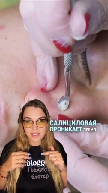 Не выдавливай а используй пилинг от прыщей wb WW152209 Cosmeya