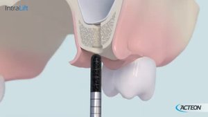 Набор насадок Satelec Intralift II (TKW1, TKW2, TKW3, TKW4, TKW5)