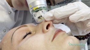 Микроигольчатый RF-лифтинг Тотальное омоложение
