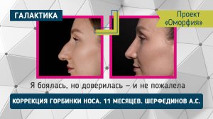 Проект "Оморфия": Как изменилась Кристина спустя 11 месяцев после ринопластики у Шерфединова