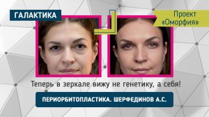 Периорбитопластика и лифтинг у Арсения Шерфединова | Победительница «Оморфии» спустя 10 месяцев