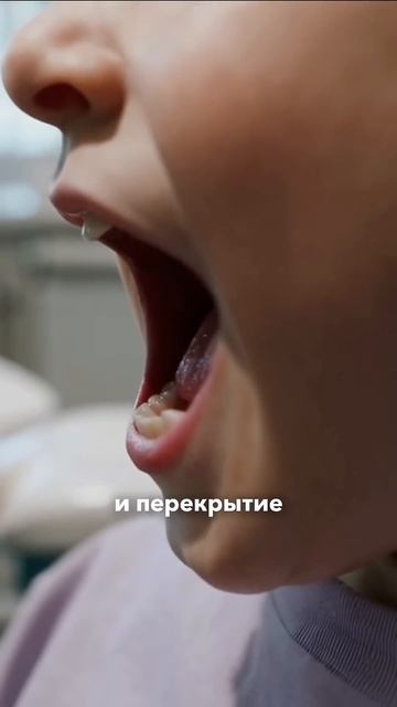 Как понять, что у ребёнка формируется неправильный прикус: тревожные признаки смотреть онлайн
