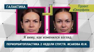 Проект "Оморфия": Периорбитопластика у Елены — реабилитация без боли, результат без фильтров
