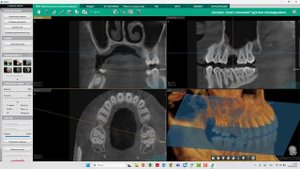 Демонстрация примера 3D-визуализации в программе Ez3D-i со Smart Plus и с имплантом
