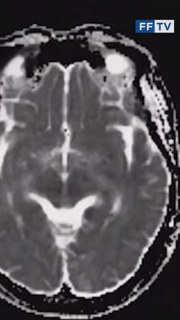 ЗАВИСИТ ЛИ КАЧЕСТВО ИССЛЕДОВАНИЯ МРТ ОТ МОЩНОСТИ АППАРАТА #здоровье #мрт #медицина #shorts