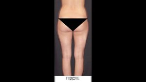 РУЧНАЯ ПЛАСТИКА ТЕЛА NEWBODYKA. КОРРЕКЦИЯ ФИГУРЫ. КАЛИНИН АЛЕКСЕЙ. РЕЗУЛЬТАТ ДО И ПОСЛЕ. ВИДЕО 2(1)