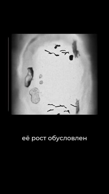 Киста или опухоль? Когда яичник нужно оперировать смотреть онлайн