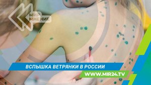 В России резко увеличилось количество случаев заболевания ветрянкой: причины и способы защиты?