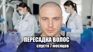 Пересадка волос спустя 7 месяцев / Клиника GG Med