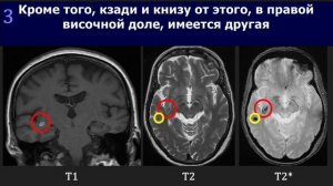 Introduction to MRI of the brain / Введение в МРТ головного мозга
