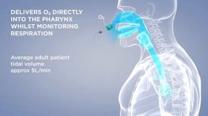 Назофарингеальный воздуховод Naso-Flo при дыхательной недостаточности, в т.ч. вызванной COVID-19