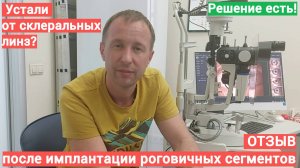 Отзыв после имплантации роговичных сегментов после ношения склеральных линз при кератоконусе