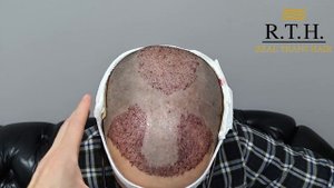 Успешное завершение двухэтапной трансплантации волос!