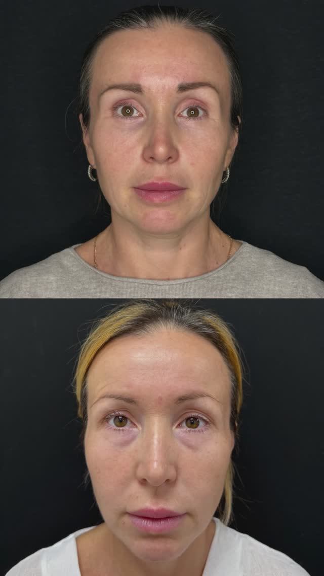 До и после блефаропластики и лобно-височного лифтинга лица смотреть онлайн