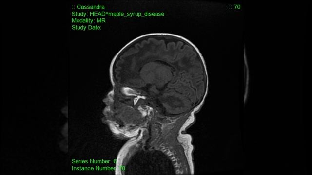Cassandra. MRI-HEAD. Болезнь Кленового Сиропа