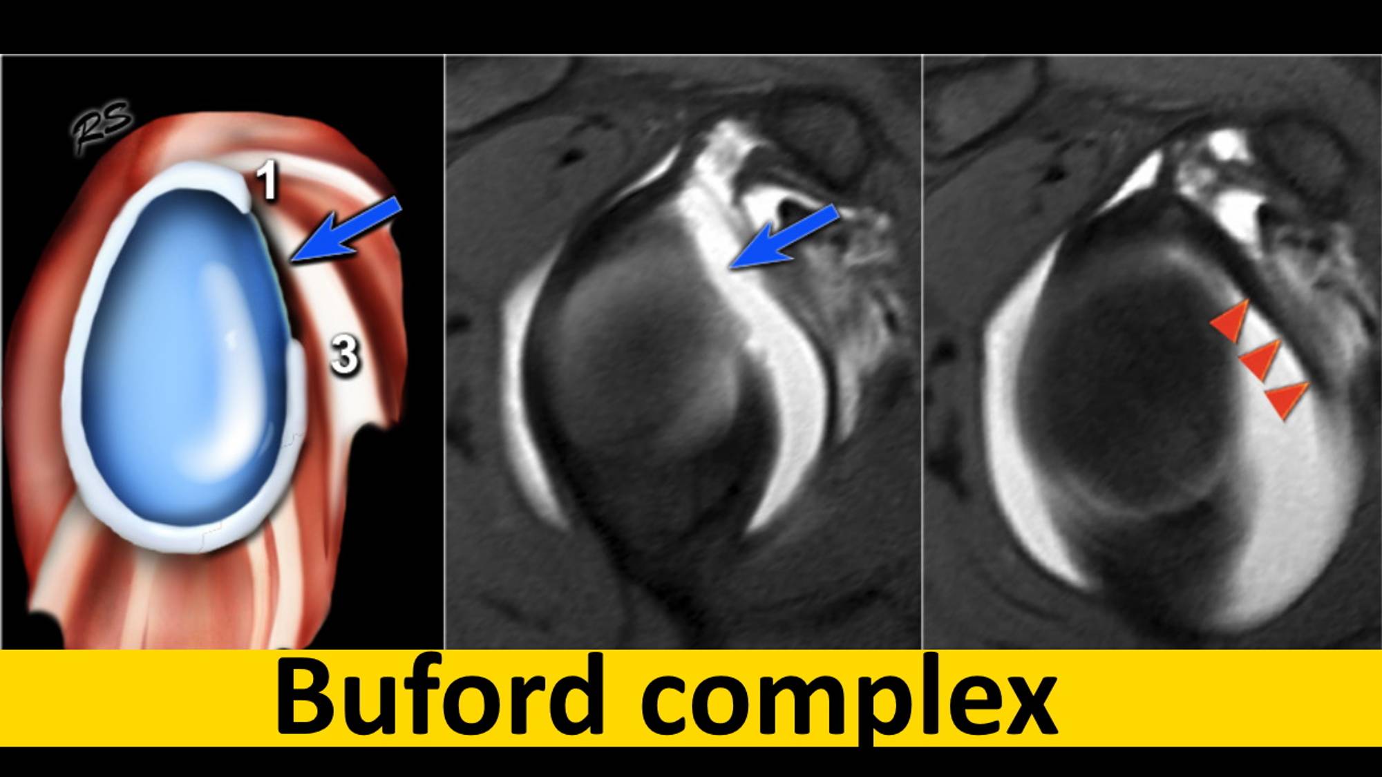 МРТ плечевого сустава  | Комплекс Буфорда | Варианты нормы
