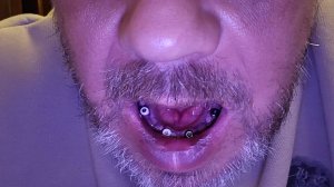 60 ЧАСОВ ПОСЛЕ ИМПЛАНТАЦИИ ЗУБОВ