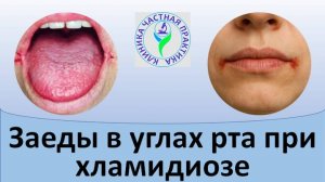 Заеды в углах рта при хламидиозе