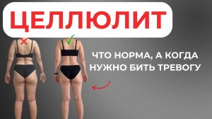 ЦЕЛЛЮЛИТ - когда является нормой, а когда бить тревогу