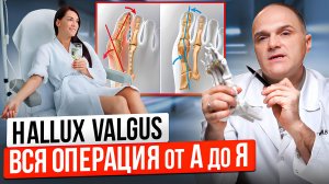 Не делайте операцию Халюс Вальгус пока не посмотрите это видео. Как проходит операция Hallux Valgus.