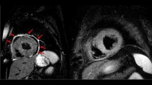 Посткардиальный синдром: сдвиг парадигмы, новая диагностика (МРТ) и таргетное лечение IL-1