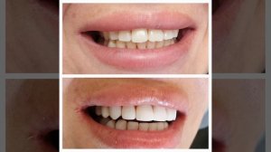 Композитные виниры - протезирование выполнено врачом Габараева Н.В.