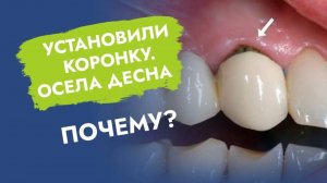 Зубная коронка стала короткой. Почему? Что делать?