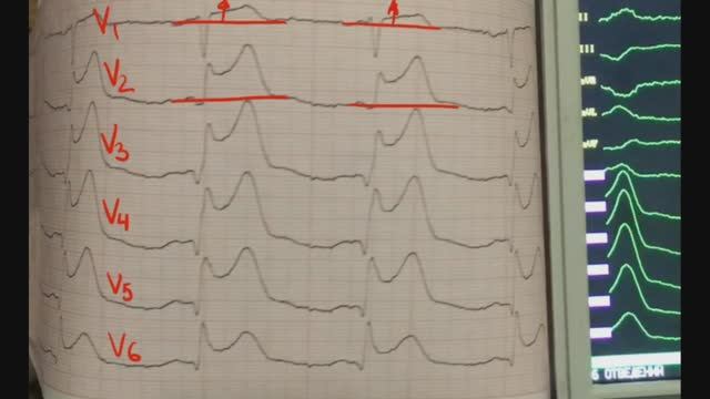 Тромболизис окс с подъемом ST смотреть онлайн