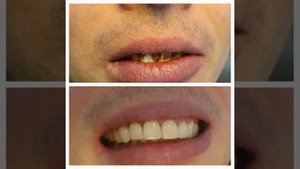 Композитные виниры - протезирование выполнено врачом Габараева Н.В.