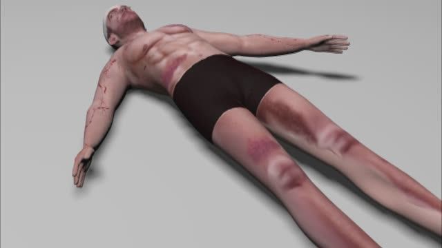 Открытый пневмоторакс. ТАКТИКА. смотреть онлайн