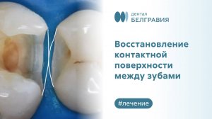 ⚕️ Восстановление контактной поверхности между зубами